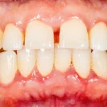 رژیمی شبیه فستینگ و التهاب لثه؛ نتایج یک مطالعه ۶ ماهه چه می‌گوید؟