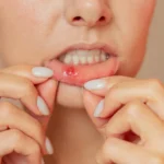 زخم دهان؛ دلایل رایج، روش‌های درمان و راه‌های پیشگیری